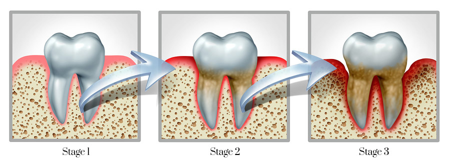 ackley-periodontitis-stages-v1
