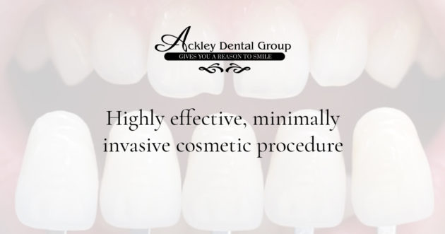 Ackley – Blog – Veneers – 1200×630 – V1
