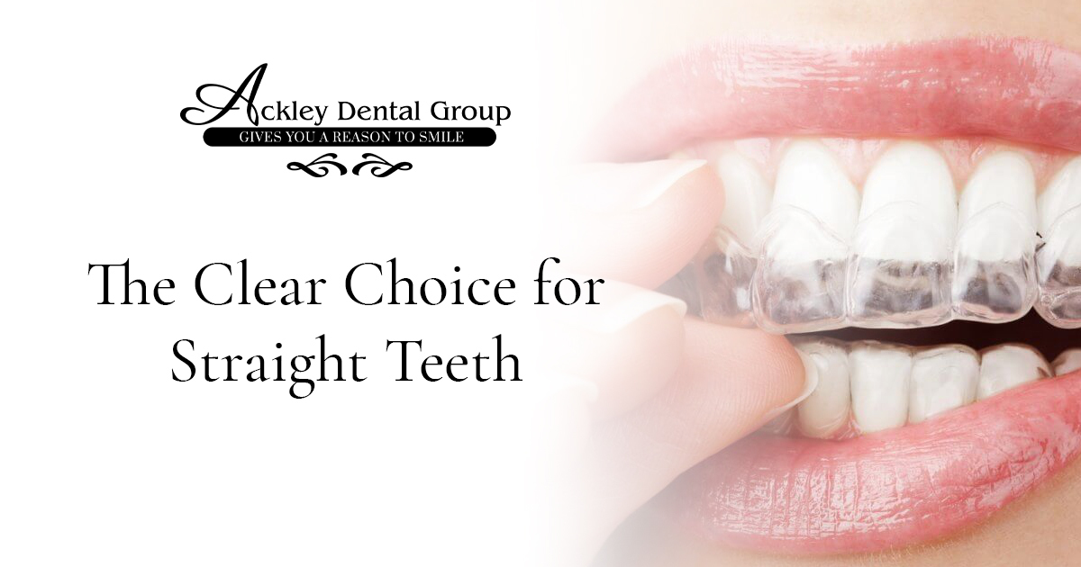 Ackley – Blog – Invisalign – 1200×630 – V1
