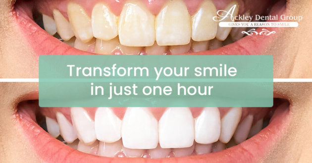 Ackley – blog-transform your smile in just one hour – 1200×630 – V1