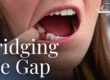 womans mouth missing a tooth